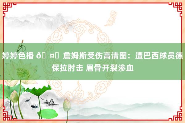 婷婷色播 ?詹姆斯受伤高清图：遭巴西球员德保拉肘击 眉骨开裂渗血